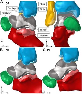 Design of a lightweight universal talus implant using topology optimization
